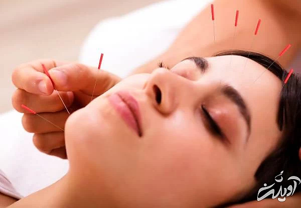 طب سوزنی صورت